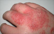 a mild case of eczema